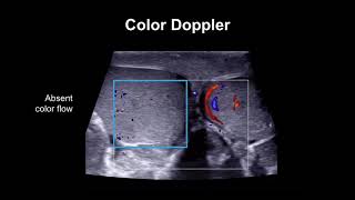 Diagnosing testicular torsion [upl. by Anialad]