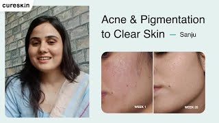 How Cureskin Helped Sanju Beat Acne Pigmentation amp Sunburn  Cureskin [upl. by Nnylkcaj715]