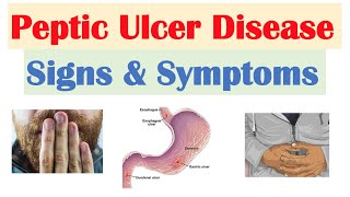 Peptic Ulcer Disease Signs amp Symptoms  Gastric vs Duodenal Ulcers [upl. by Nnylirak]