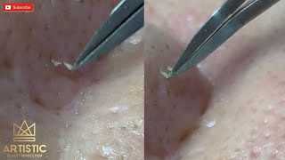 blackheads filaments on nose remove with tweezers กดสิว [upl. by Neerehs]