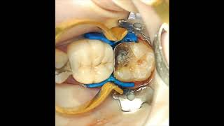 Restoring that broken molar and the difficult class II cavity [upl. by Eaneg]