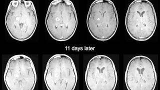 HIV and CNS Opportunistic Infections in HIV [upl. by Dasi613]