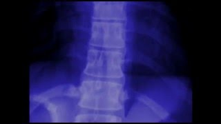 Areas of Inflammation in Ankylosing Spondylitis [upl. by Alejandrina]