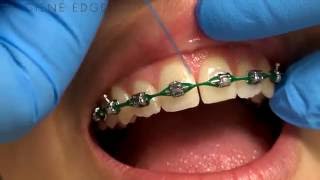 Flossing Braces With a Threader [upl. by Ailongam]