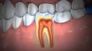 Treatment of Abscessed Teeth [upl. by Enyluqcaj373]