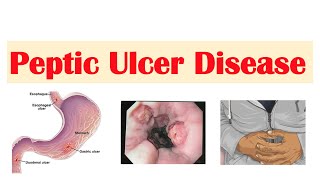 Peptic Ulcer Disease Gastric vs Duodenal Ulcers  Causes Symptoms Diagnosis Treatment [upl. by Yaresed]