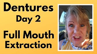 Immediate Dentures Full Mouth Extraction Day 2 [upl. by Anitirhc46]