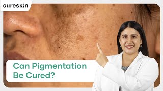 How Long Does It Take to Cure Pigmentation  Cureskin [upl. by Ardnahcal]