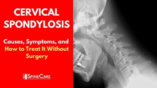 CERVICAL SPONDYLOSIS Causes Symptoms and Treatment NO SURGERY [upl. by Nairbal597]