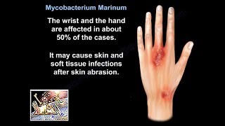 Mycobacterium Marinum  Everything You Need To Know  Dr Nabil Ebraheim [upl. by Arelc]