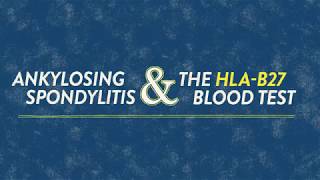 HLAB27 An Important Genetic Marker for Ankylosing Spondylitis [upl. by Nalo]