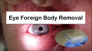 Eye Foreign Body Removal [upl. by Emaj]