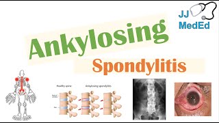 Ankylosing Spondylitis  HLAB27 Pathophysiology Signs amp Symptoms Diagnosis Treatment [upl. by Paugh]