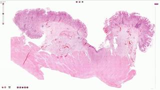 Peptic Ulcer  Histopathology [upl. by Ecnerat]