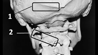 What is Occiptial Neuralgia [upl. by Alleroif]