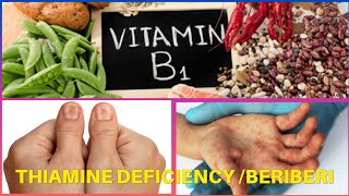 BeriBeri  Thiamine deficiency [upl. by Loise814]