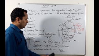 Part1 Ulcer Pathophysiology Gastric peptic duodenal ulcer [upl. by Josephina]