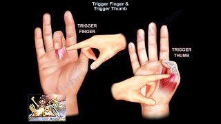 Trigger Finger amp Trigger Thumb  Everything You Need To Know  Dr Nabil Ebraheim [upl. by Attenej216]