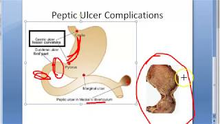 Pathology 521 b Peptic Ulcer Complications [upl. by Anum]