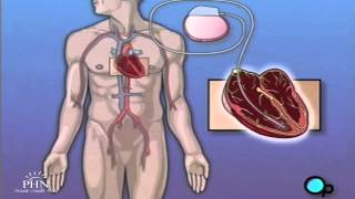 Permanent Pacemaker Implant Surgery [upl. by Pickar400]