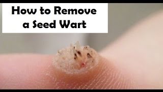 How to Remove a Seed Wart  Treatment for Seed Warts [upl. by Joliet]