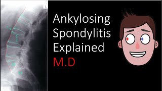 Ankylosing Spondylitis Explained [upl. by Mauro534]