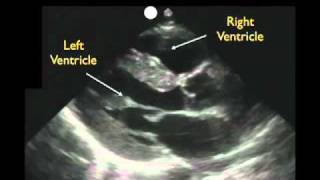 Cystoscopy  Animated Atlas of BPH and OAB [upl. by Pancho]