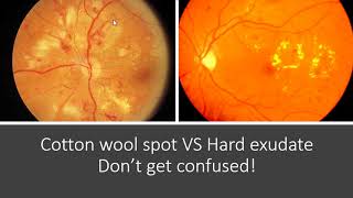 How to Prevent Macular Degeneration – Dr Berg [upl. by Sitnerp608]