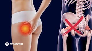 Pain in the butt  Its NOT Piriformis Syndrome [upl. by Ardnu]