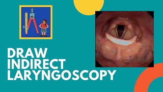 Draw Indirect Laryngoscopy Findings [upl. by Frederico325]