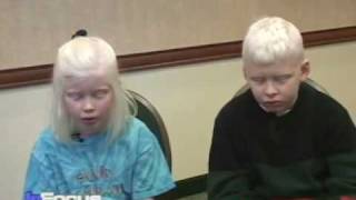 African Albinos on VOAs In Focus [upl. by Nett]