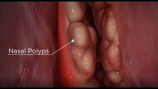 Do polyps stop you getting pregnant amp its management  Dr Rashmi Yogish [upl. by Yentroc832]