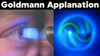 Goldmann Applanation Tonometry Procedure Technique Tutorial [upl. by Jeanne]