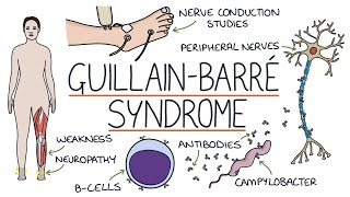 Understanding GuillainBarré Syndrome [upl. by Isyad618]