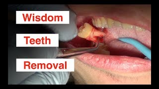 Wisdom Teeth Removal [upl. by Hait]