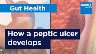 How a peptic ulcer develops  Bupa Health [upl. by Lorianna]