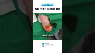 발톱 안 뽑는 내성발톱 치료Ingrown nail treatment [upl. by Sidran942]