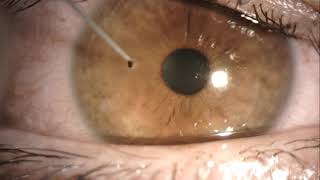 corneal foreign body removal like a boss [upl. by Onitrof]