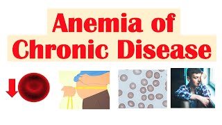 Anemia of Chronic Disease  Causes Pathophysiology Signs amp Symptoms Diagnosis Treatment [upl. by Nobe]