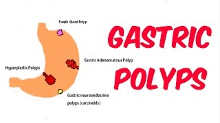 What Are Colon Polyps [upl. by Winnie]