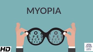 My Rare Eye Condition  Myopia  Thick Glasses  Full Story [upl. by Cumine908]