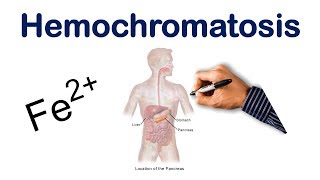 Hemochromatosis  USMLE COMLEX NCLEX [upl. by Yznil383]