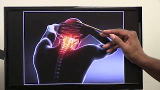 Occipital neuralgia  Symptoms amp Treatments so EVERYBODY Understands [upl. by Okir973]