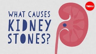 What causes kidney stones  Arash Shadman [upl. by Venu125]