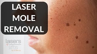 LASER MOLE REMOVAL [upl. by Aipotu]