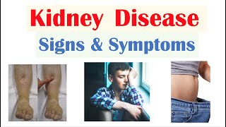 Kidney Renal Disease Signs amp Symptoms ex Peripheral Edema Fatigue Itchiness [upl. by Dewain542]