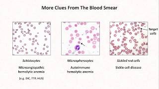 Anemia Lesson 4  Clues from the blood smear [upl. by Buffy]