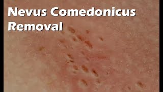 Nevus Comedonicus Removal  9 minutes worth [upl. by Ivets]