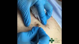 Removal of Seborrheic Keratosis [upl. by Eical216]