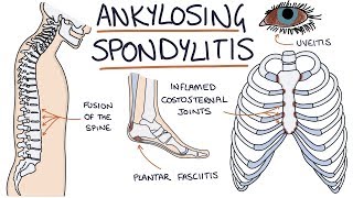 Ankylosing Spondylitis Visual Explanation for Students [upl. by Derwood327]